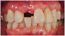 バルプラスト義歯術前