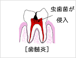 歯髄炎